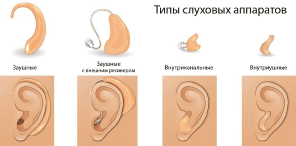 Топ-10 лучших слуховых аппаратов, как выбрать усилитель звука